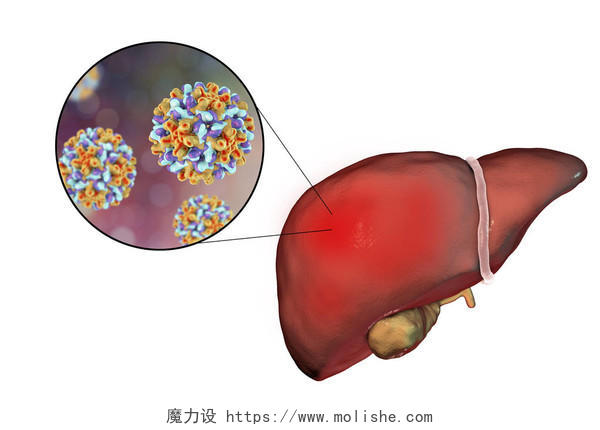 肝与 B 型肝炎感染和特写视图的乙型肝炎病毒3d 图